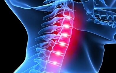 Symptoms of osteochondosis of the cervical column