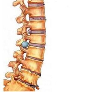 How the osteochondosis of the cervical region develops