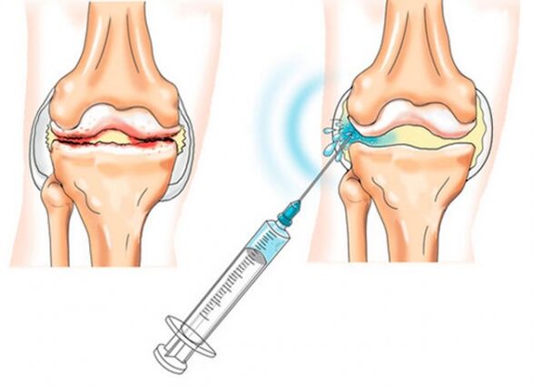 intra-articular injections for knee osteoarthritis